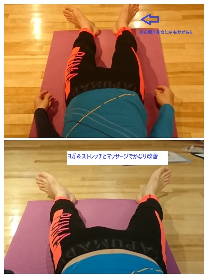 画像に alt 属性が指定されていません。ファイル名: 足首歪み.jpg